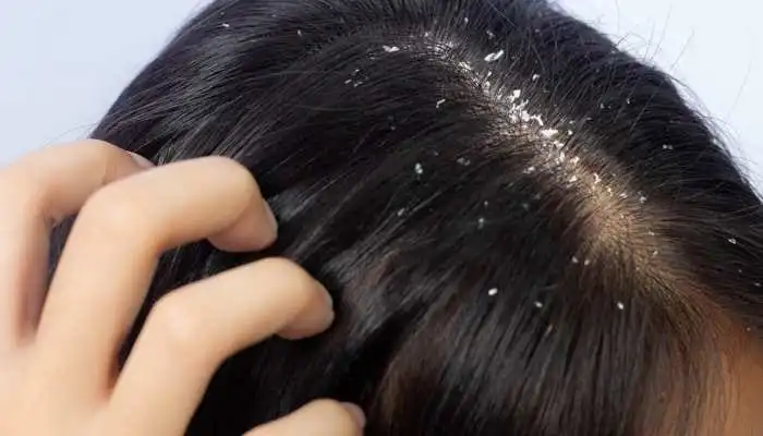 Benefits of Tea Tree Oil for Healthy Scalp and Hair