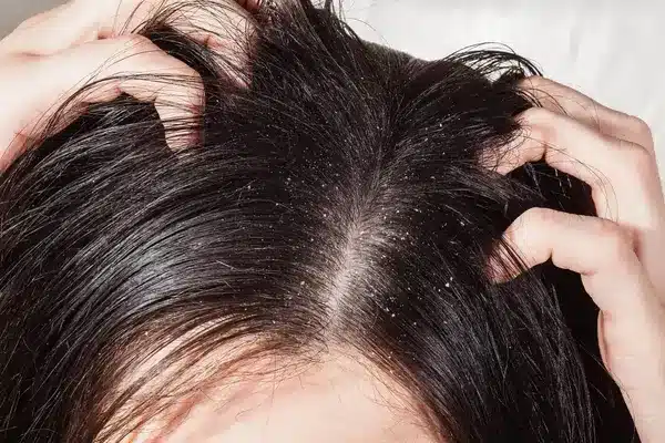Dandruff scalp
