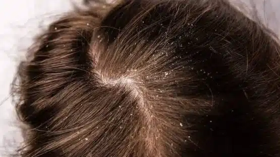 the image shows the scalp with dirt, dust which indicates unclean scalp