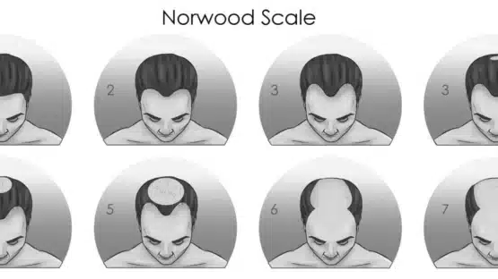 the image shows the visual explanation of men baldness
