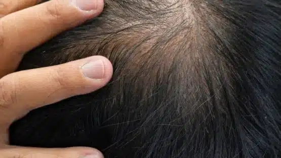 Male pattern hair loss