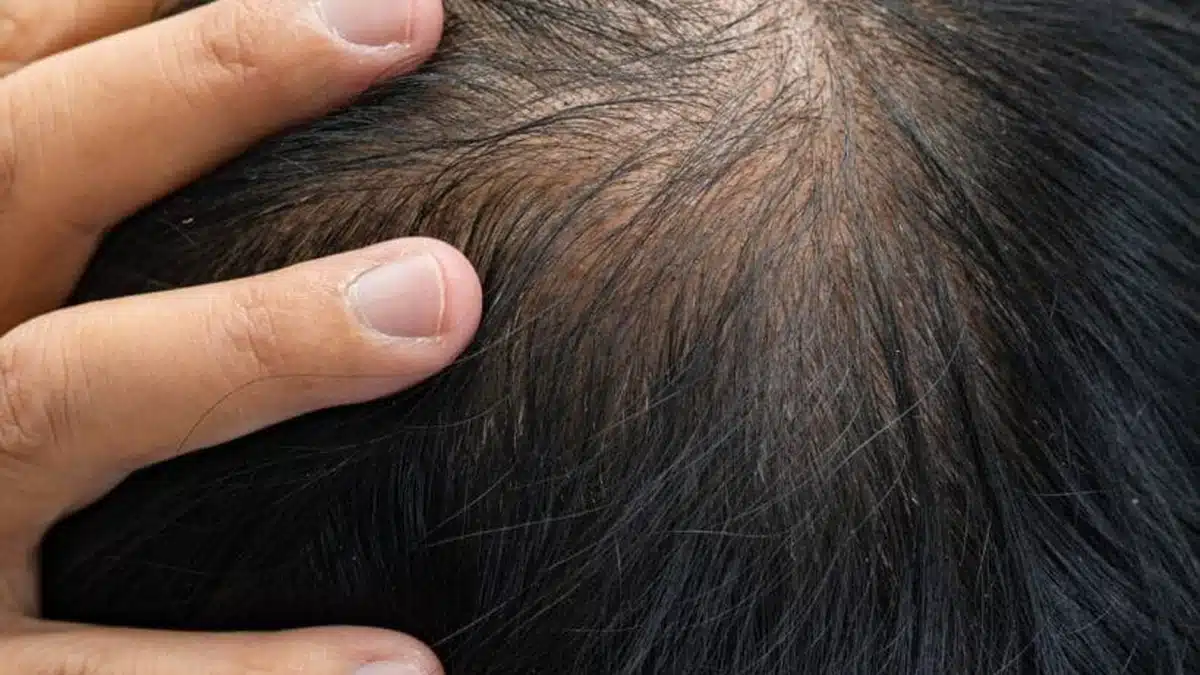 Male pattern hair loss